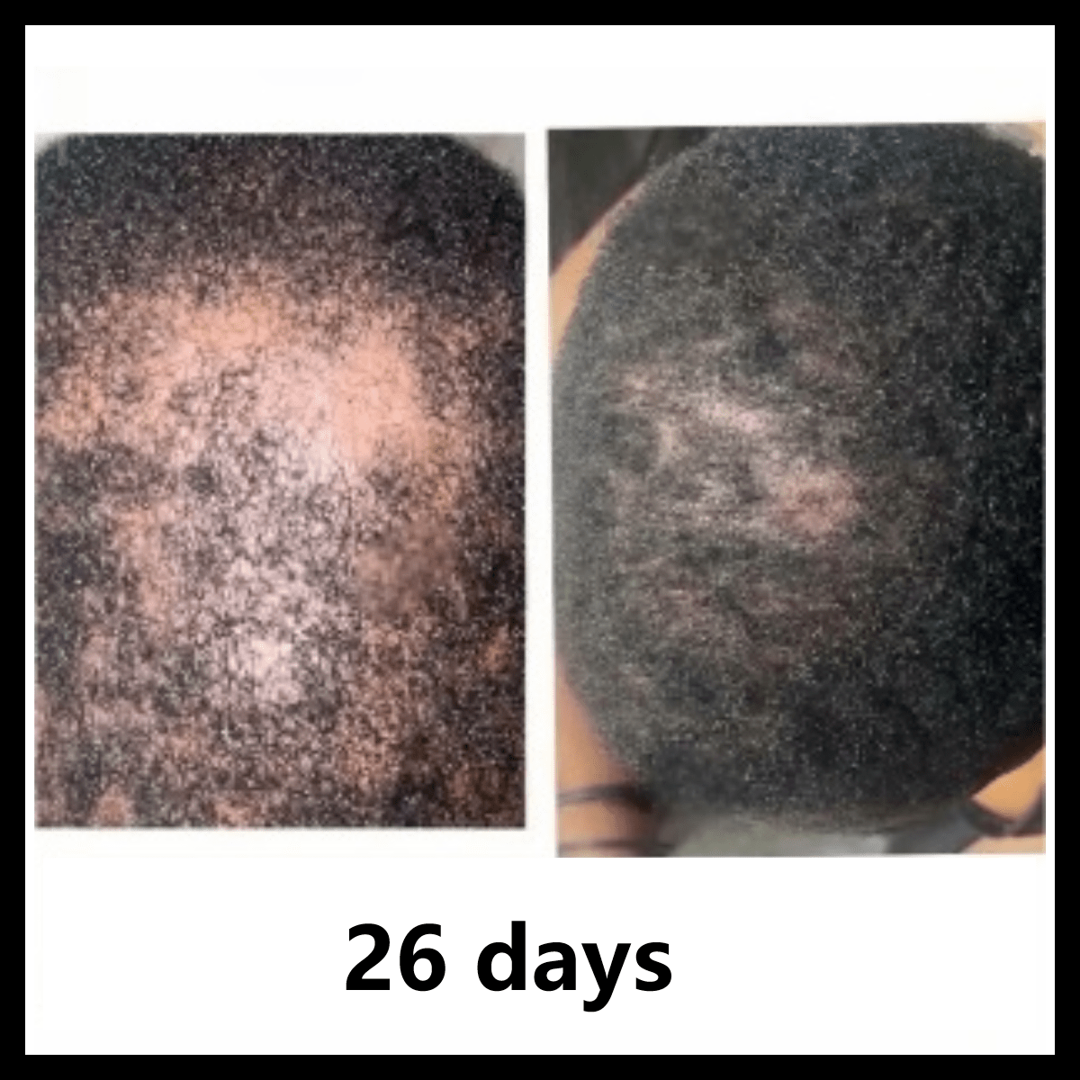 BaliAga Kemiri Oil – Natural Hair Growth Oil | Helps Hair Grow Longer, Stronger & Healthier - Bali Aga Beauty